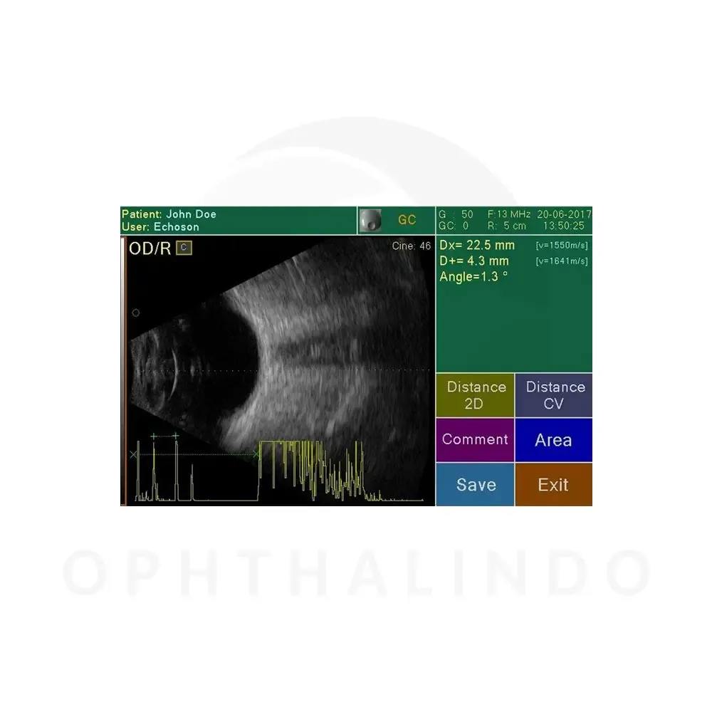 ECHOSON Biometry B-Scan — view 2